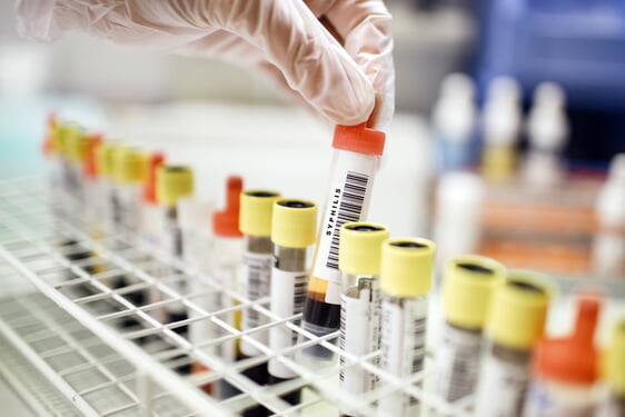 Die schnelle Diagnose von Geschlechtskrankheiten verhindert deren Ausbreitung und schützt Patienten vor nicht reparablen Spätfolgen. Foto: AOK